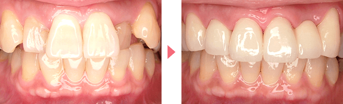 側切歯口蓋側転移・形態不全の治療