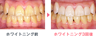 ホワイトニングビフォーアフター