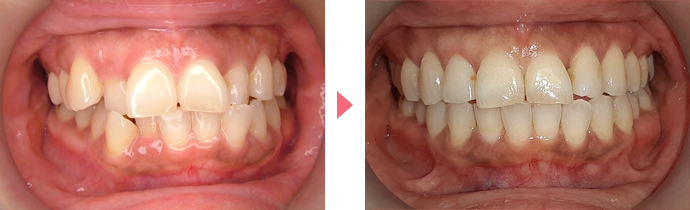 インビザライン・システムの治療