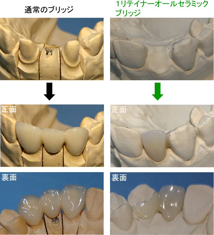 １リテイナーオールセラミックブリッジ