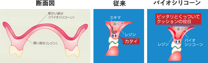 不快感を改善してくれるのがバイオシリコーン床義歯