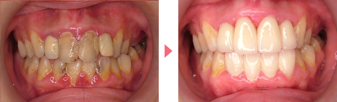 歯の変色の治療