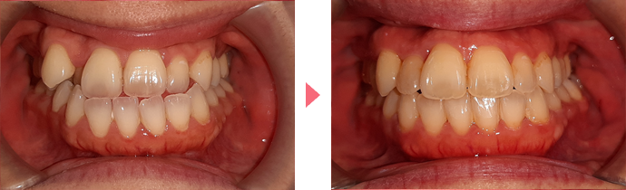 インビザライン・システムの治療
