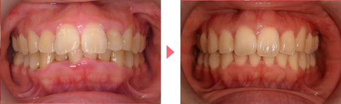 インビザライン・システムの治療