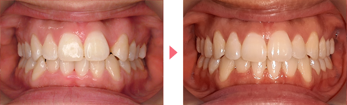 インビザライン・システムの治療