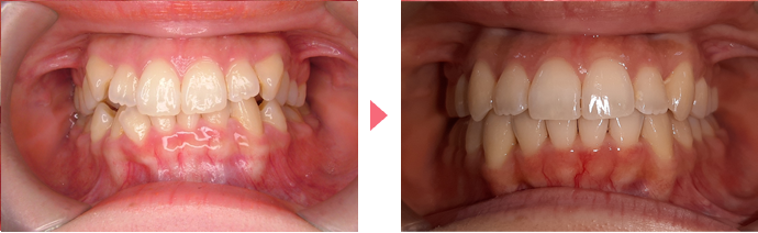インビザライン・システムの治療